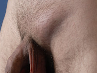 LGV: Lymphogranuloma venereum