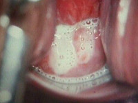 Trichomonas vaginalis, trichomoniasis