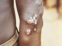 Framboesia tropica (yaws)