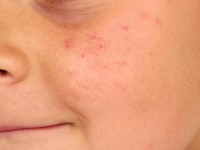 Spider nevus, naevus araneus