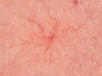 Spider nevus, naevus araneus