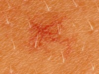 Spider nevus, naevus araneus