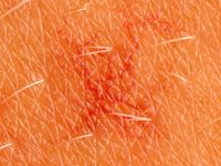 Spider nevus, naevus araneus