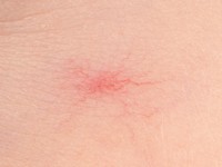 Spider nevus, naevus araneus