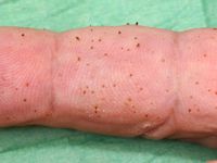 Spiny keratoderma