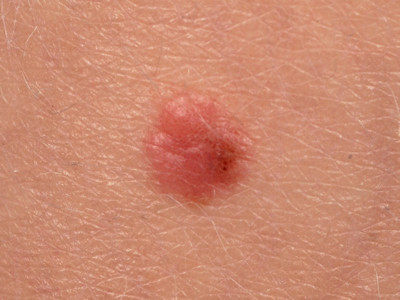 Spitz nevus