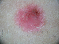 Dermatoscopie Spitz nevus, dotted vessels
