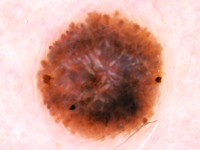 Dermatoscopie Spitz nevus, globular pattern with reticular depigmentation