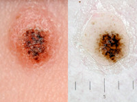 Spitz nevus