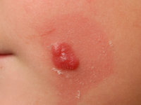 Spitz nevus