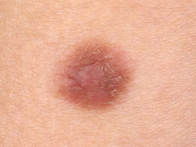 Spitz nevus