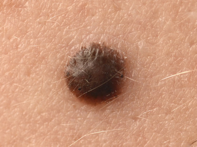 Spitz nevus