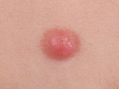 Spitz nevus