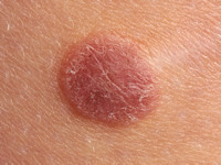 Spitz nevus
