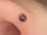 Spitz nevus