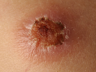 STUMP, Spitzoid melanoma