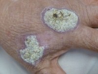 Sporotrichosis