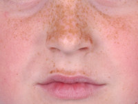 Freckles