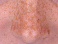 Freckles