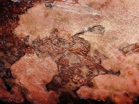 Staphylococcal scalded skin syndrome