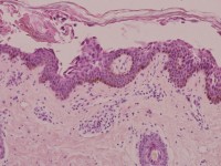 Staphylococcal scalded skin syndrome