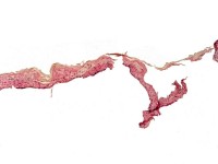 Staphylococcal scalded skin syndrome