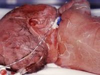 Staphylococcal scalded skin syndrome