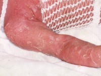 Staphylococcal scalded skin syndrome
