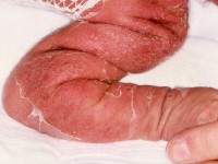 Staphylococcal scalded skin syndrome