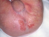 Staphylococcal scalded skin syndrome