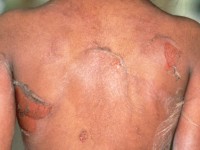 Staphylococcal scalded skin syndrome