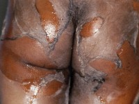 Staphylococcal scalded skin syndrome