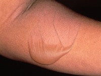 Staphylococcal scalded skin syndrome