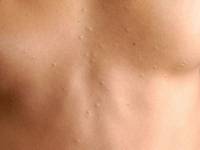 Steatocystoma multiplex