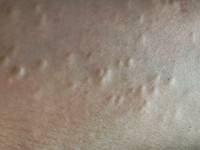 Steatocystoma multiplex