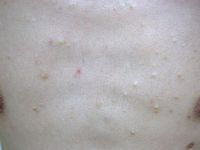 Steatocystoma multiplex