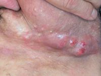 Steatocystoma multiplex