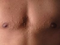 Steatocystoma multiplex