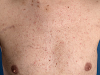 Steroid acne