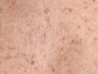 Steroid acne