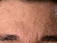 Steroid acne