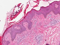 Histologisch beeld bij Still's disease