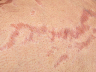 stria, striemen, stretchmarks