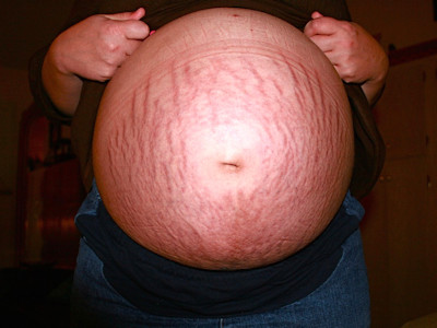 stria, stretch marks, stretch marks