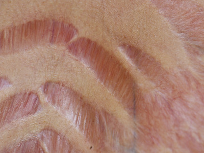 stretch marks as a side effect of corticosteroids