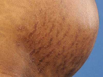 stria, stretch marks, stretch marks