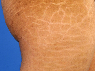 stria, striemen, stretchmarks