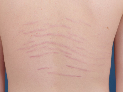 striae due to growth during puberty