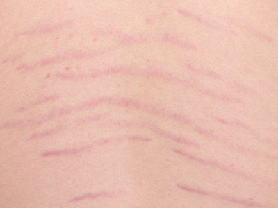 striae due to growth during puberty