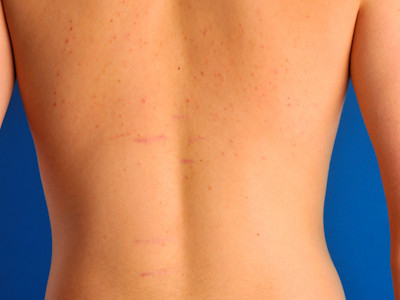 stria door groei in de puberteit